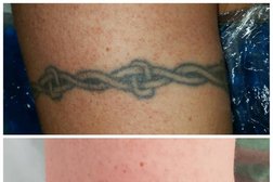 NOT Forever Body Art Removal Photo