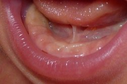 Tongue tie Solutions Photo