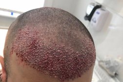 London Hair and Cosmetic Surgical Centre - FUE Hair Transplant by a very senior doctor (consultant) Photo