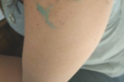 Fresh start tattoo removal in Bournemouth