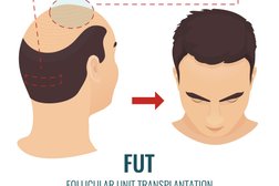 Manchester Hair Transplant Clinic in Manchester