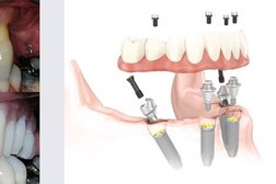 Herschel Dental & Implant Centre in Slough