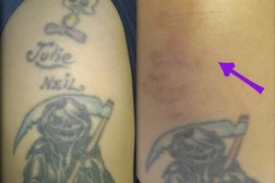 Redeem Clinic - Tattoo removal Hull in Kingston upon Hull